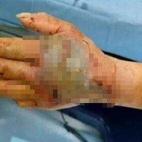 72岁大爷杀死剧毒眼镜蛇，5分钟后离断蛇头突然“复仇”，毒牙狠狠刺入其掌心，大爷被紧急送医抢救！术后大爷说连做三天噩梦，蛇追着他咬
