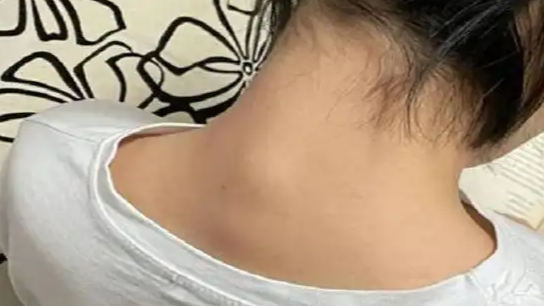 颈后鼓包其实是颈椎在求救