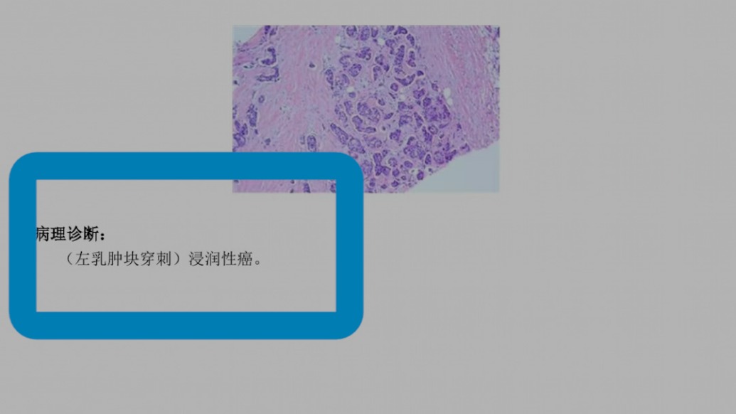女子体检正常半年多后确诊乳腺癌，江苏省省级机关医院：报告结论客观，将再次开展调查
_锋线视频