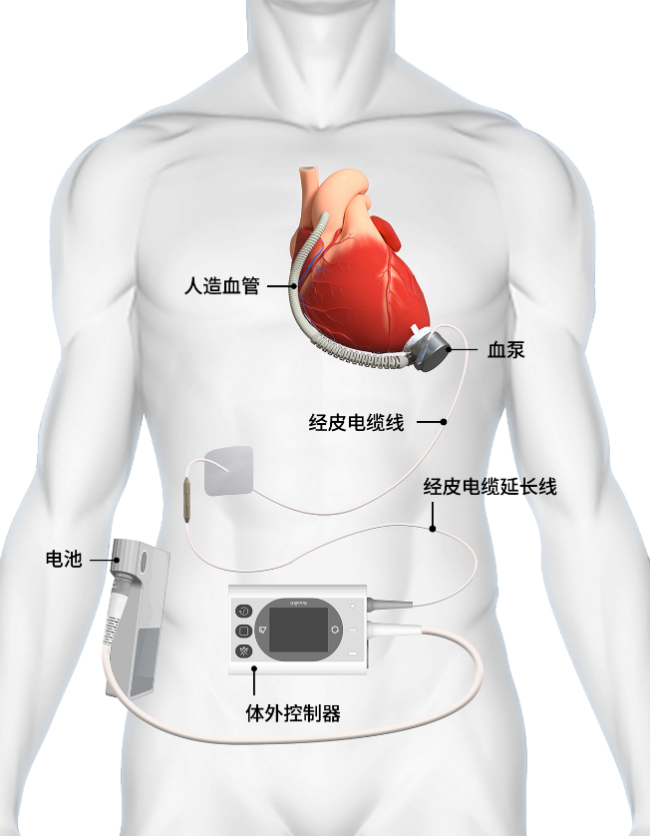 人工心脏的“奇点时刻”：新一代全磁悬浮如何影响全球临床版图