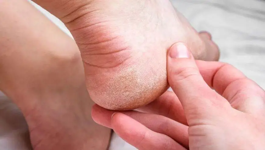 脚后跟开裂是缺乏维生素或者胶原蛋白？