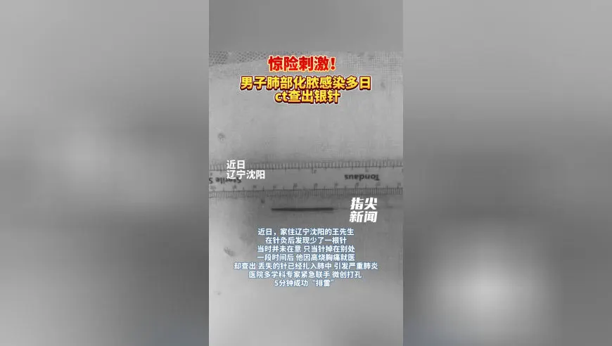 男子严重肺炎数日不好，CT检查竟发现针灸银针