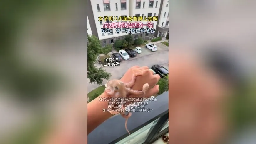 女子将八爪鱼放胳膊上拍照，皮肉被咬得凹进去一块，医生：第一次接这种急诊