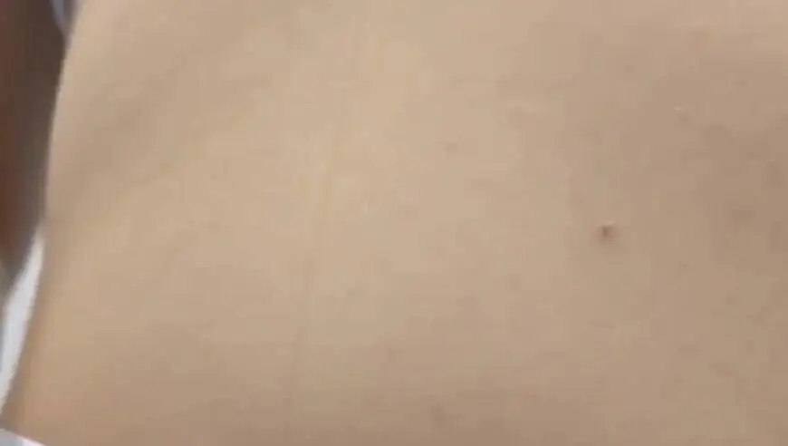 女子网购减肥针，加量注射，短短一个月暴瘦10公斤，结果停针2个月后比之前还胖！医生：减重需综合管理，依赖药物“躺瘦”不现实
